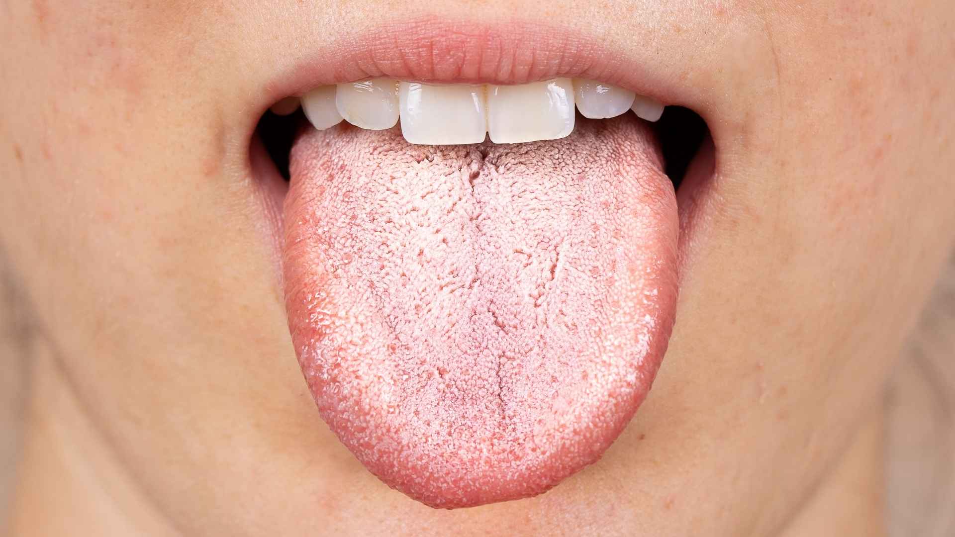 Persona con la lengua blanca