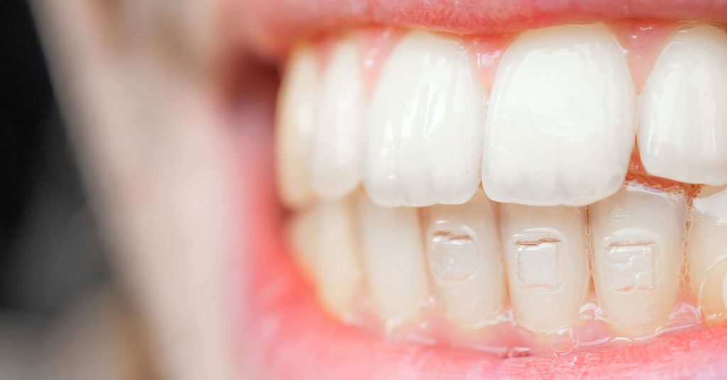 ¿Qué son y para qué sirven los ataches dentales?