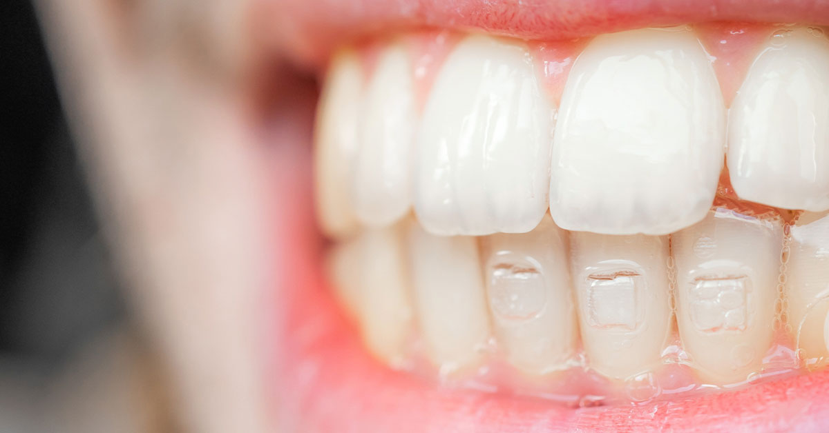 close up de ataches dentales colocados sobre dientes para ortodoncia invisible