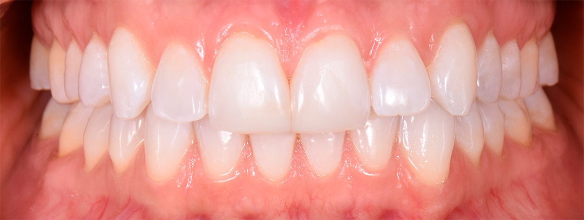 fotografía dientes de paciente real en clínica
