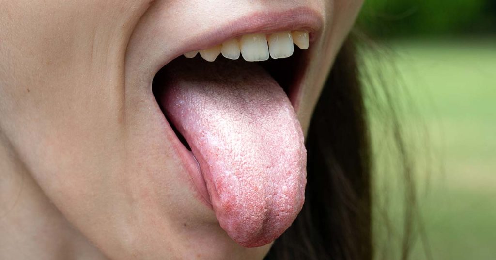 Saburra lingual: ¿cómo limpiar la lengua blanca?