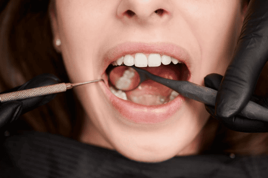 sarro de los dientes